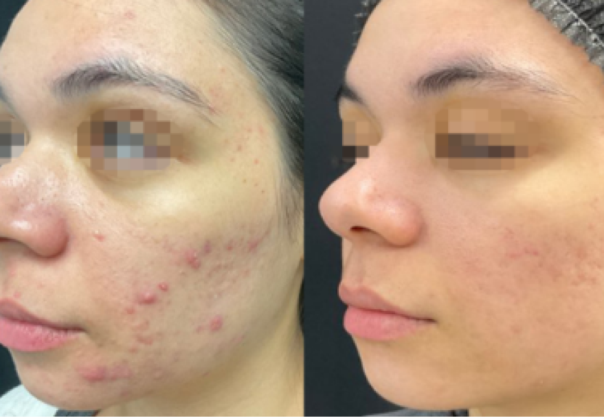 Opus Resurfacing Treatment