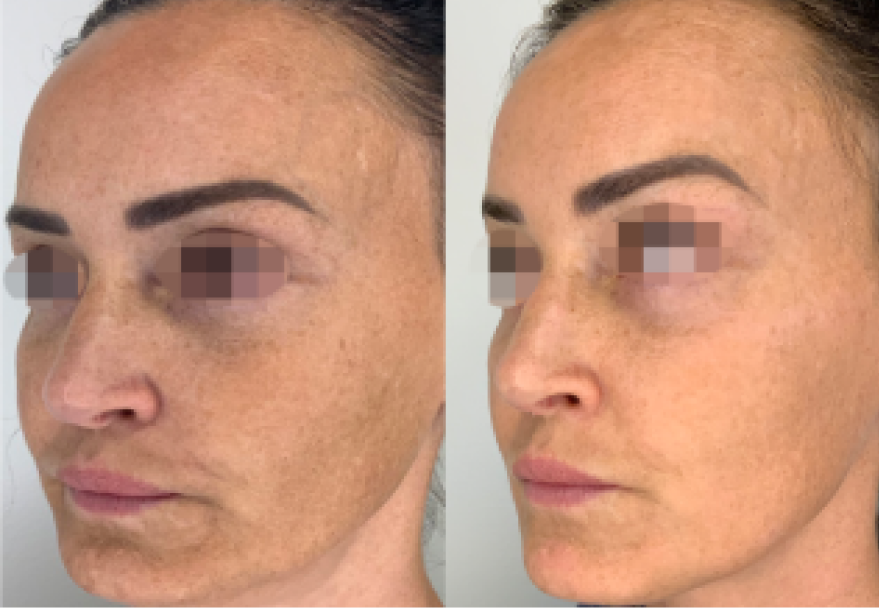 Opus Resurfacing Treatment