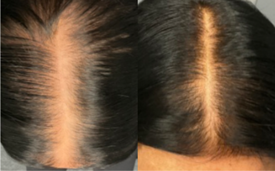 TED Hair Restoration Treatment