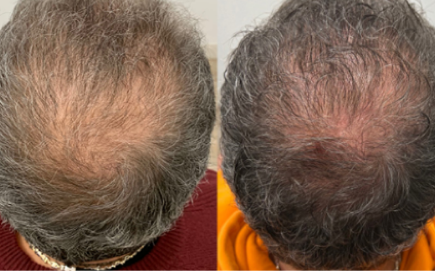 TED Hair Restoration Treatment