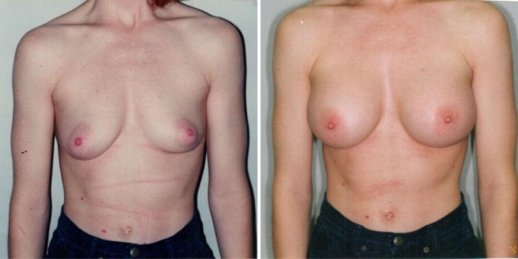 Breast Augmentation Befor After