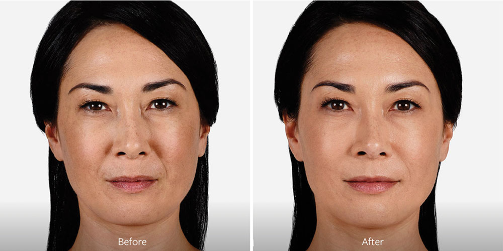Injectables Before After